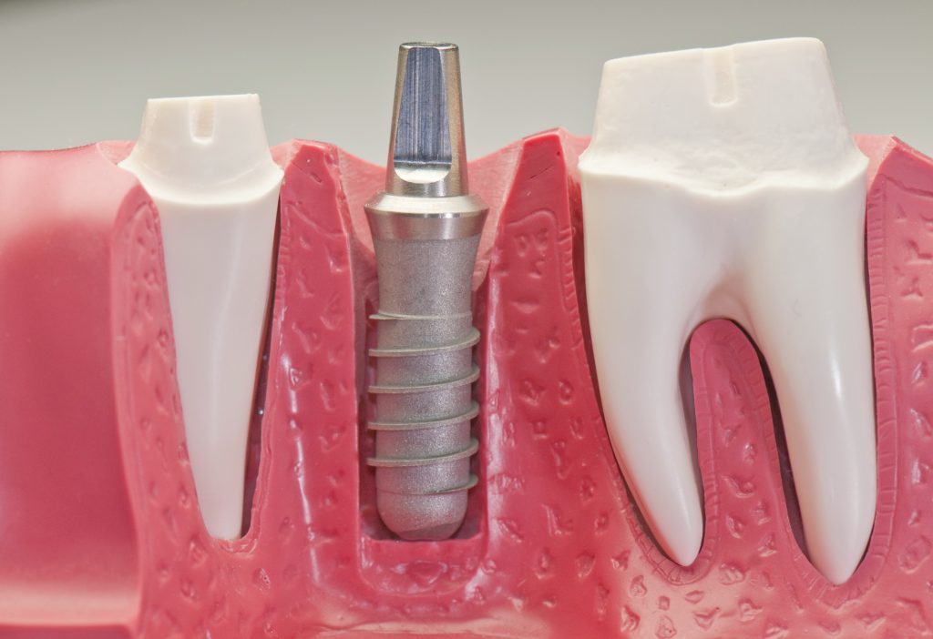 Seattle Smiles Dental Implant Model