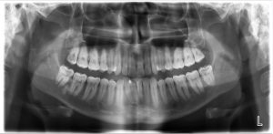 Seattle Smiles Dental – Panoramic Xray Services