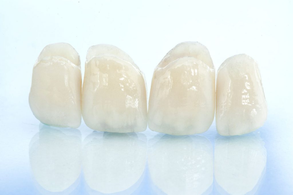 Seattle Smiles Dental – Crowns