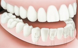 Seattle Smiles Dental – Bridge Implants