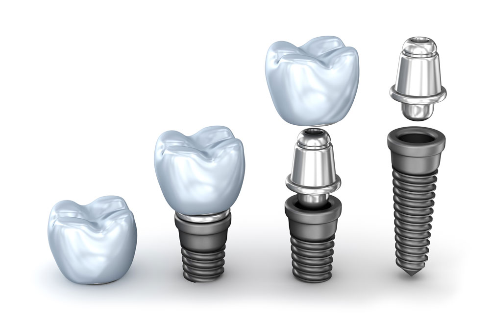 Implant crown attaches to an abutment which is attached to the implant