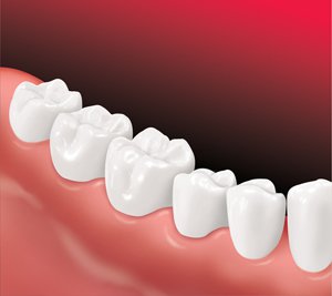 Seattle Smiles Dental – Implant Bridge