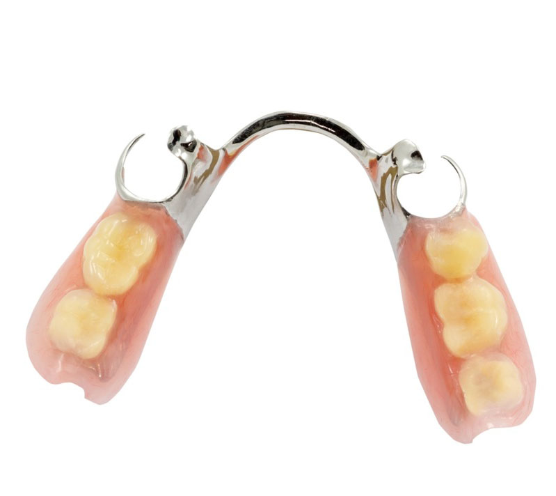 Seattle Smiles Dental – Cast-metal style of partial denture