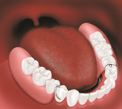 Seattle Smiles Dental – Partial denture