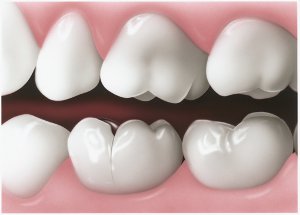 Seattle Smiles Dental – Cracked Tooth