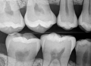 Seattle Smiles Dental – Digital Xrays