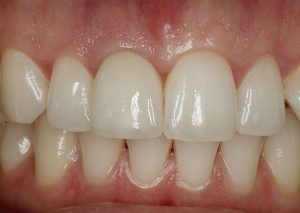 after image of dental implant in front tooth