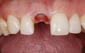 before image of dental implant in front tooth