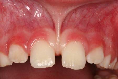 Seattle Smiles Dental – Frenectomy Labial Diastema Services