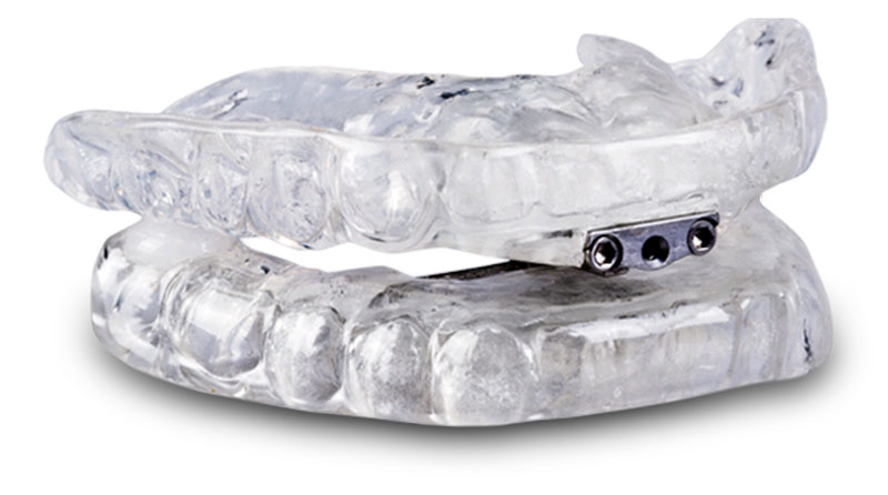 Seattle Smiles Dental – Sleep Apnea Tap3 Appliance