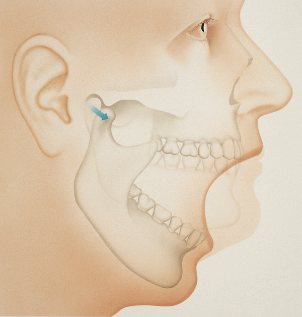 The temporomandibular joint (TMJ)