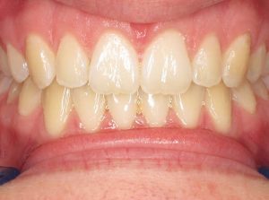 Invisalign orthodontic treatment after treating a space or diastema between upper front teeth and an anterior open bite