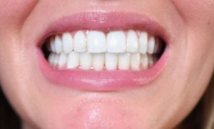 invisalign orthodontic treatment after invisalign straightens teeth and closes an open bite