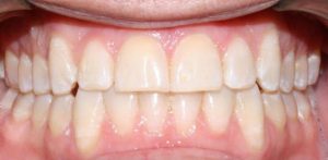 invisalign orthodontic treatment after treating an underbite