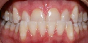 invisalign orthodontic treatment before treating an underbite