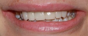 after image of dental cosmetic porcelain crowns and bridge anterior view