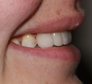 after image of dental cosmetic porcelain crowns and bridge side view