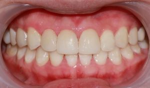 after image of dental cosmetic porcelain crowns and composite resin fillings and periodontal (gum) therapy
