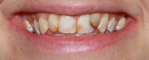 before image of dental cosmetic porcelain crowns and bridge anterior smile view
