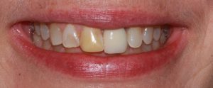 before image of dental cosmetic porcelain crowns
