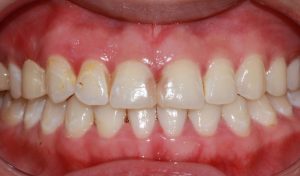 before image of dental cosmetic porcelain crowns and composite resin fillings and periodontal (gum) therapy