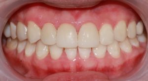 after image of dental cosmetic porcelain crowns and composite resin fillings and periodontal (gum) therapy