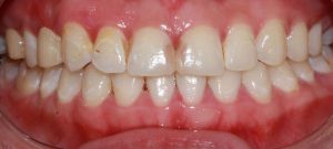 before image of dental cosmetic porcelain crowns and composite resin fillings and periodontal (gum) therapy